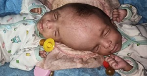 لإنقاذ توأمين ملتصقي الرأس: إعلاميون يحركون أقلامهم ﻹطلاق حلمة انسانية بحضرموت