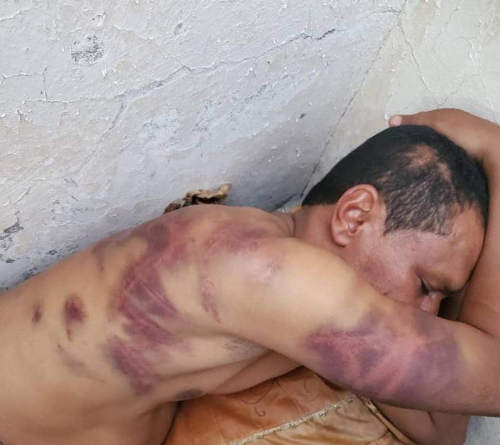 مواطن يتعرض لتعذيب بشع في مسقط رأس محافظ شبوة (صور)