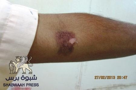 الناشط /عارف الحالمي يناشد المهتمين والمختصين لمساعدته في كشف ومعرفة المادة المحرمة التي اصابته اثناء احتجاجات يوم الكرامة.