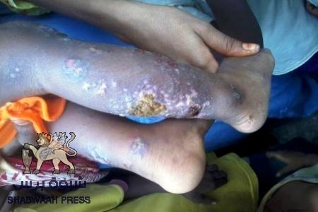 إلى فاعلي الخير: طفل من المكلا يعاني وأسرته المكونة من ثمانية أفراد من مرض جلدي غريب