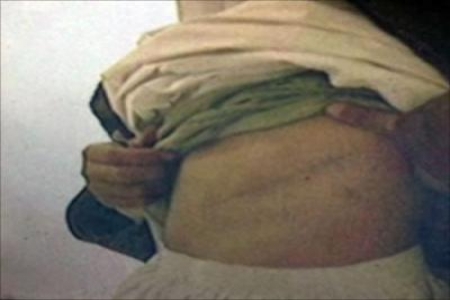 تجارة الأعضاء البشرية : تغطية خاصة للجزيرة نت عن بيع الكلى باليمن