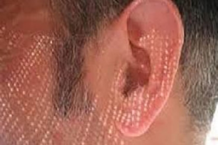 أذن صناعية 3D