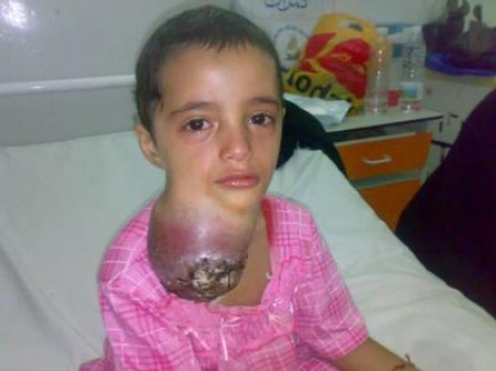 سرطان الأطفال في عدن قاتل صامت ..فمن يتصدى له ؟