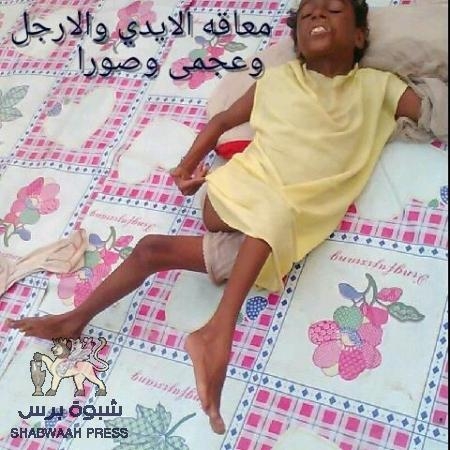 مؤسسة خيرية في أبين تناشد محبي فعل الخير تزويدها بـ 50 كرسي متحرك للمعاقين(صور)