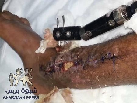 جرحى المقاومة في السودان يطالبون بإقالة وزير الصحة باعوم من منصبه