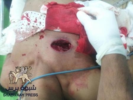 جريح جنوبي من جبهة ‘‘كهبوب‘‘ بحاجة لمساعدة أخوانه الجنوبيين