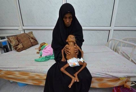 السعودية تتبرع بـ10 ملايين دولار للتصدي لسوء التغذية في اليمن