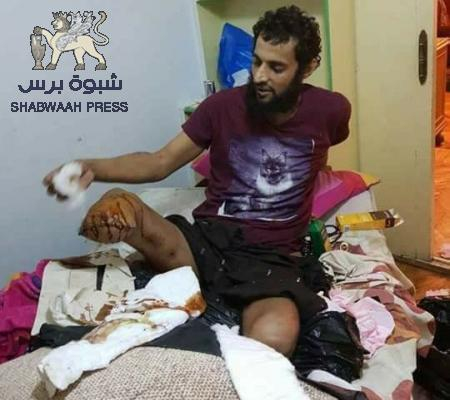 الجريح المقاوم ‘‘فهد حسين الجنيدي‘‘ فقد ساقيه متواجد في مصر وأهمل من سلطة هادي وبن دغر(صور)