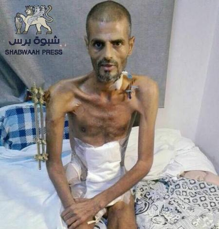جرحى المقاومة الجنوبية يعانون الإهمال والشرعية تنفق ملايين الدولارات سفها(صور)