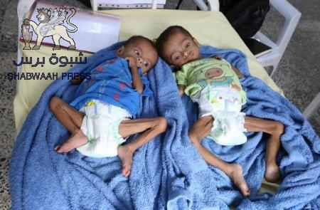 #شبـوة محافظة منكوبة : 5 وفيات بمرض الحصبة..