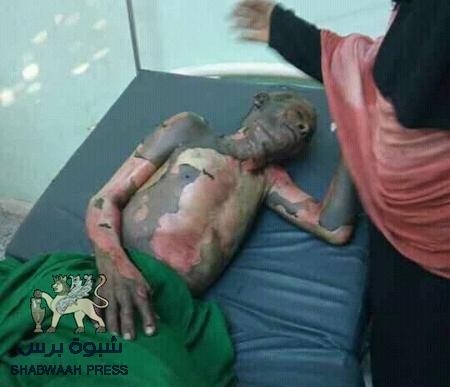 وفاة النازح الذي احرق نفسه في زنجبار بسبب الجوع والفقر
