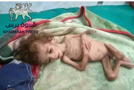 صور موجعة لأطفال الأزارق بالضالع يعانون الجوع وسوء التغذية