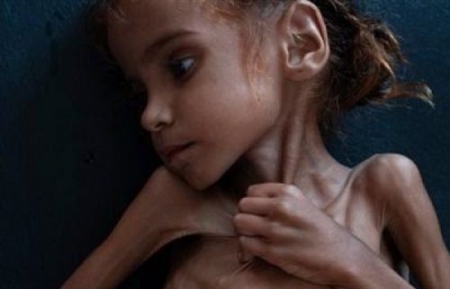 صحيفة أمريكية تنعي وفاة طفلة يمنية أصبحت صورتها رمزاً للمجاعة