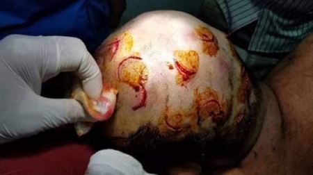 جنود الحماية الرئاسية يعتدون على طالب جامعي ويضربونه رأسه بآلة حادة بسبب موقفه الرافض للشرعية (صور)